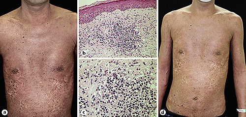 Fig. 1. a Extensive dark erythema on the trunk and extremities. b, c Band-like infiltration of atypical lymphocytes with epidermotropism in the superficial dermis. d The administration of mogamulizumab improved the mSWAT score from 104 to 40.