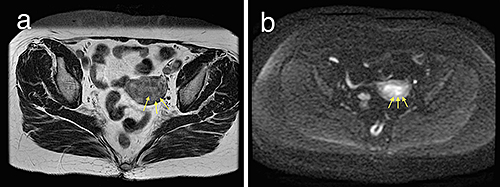 Fig. 2. Findings on contrast-enhanced magnetic resonance imaging. a On T2-weighted imaging, junctional zone was unclear especially on the posterior wall (arrows) and further high intensity from the endometrium area suggested myometrial invasion of the cancer. b High intensity in diffusion-weighted image and low intensity of apparent diffusion coefficient was consistent with myometrial invasion on T2-weighted imaging (arrows).