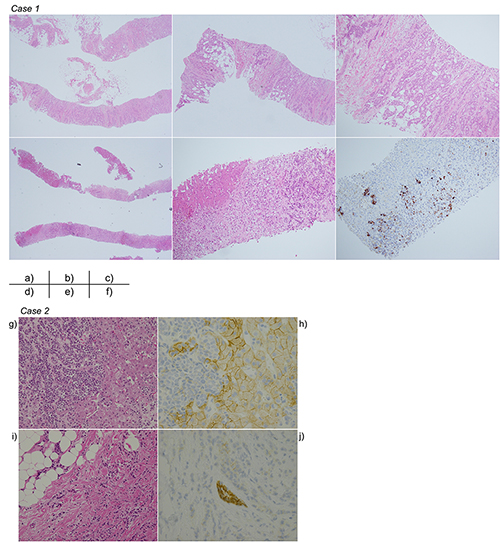 Acute Liver Failure with Diffuse Liver Metastasis from Breast Cancer