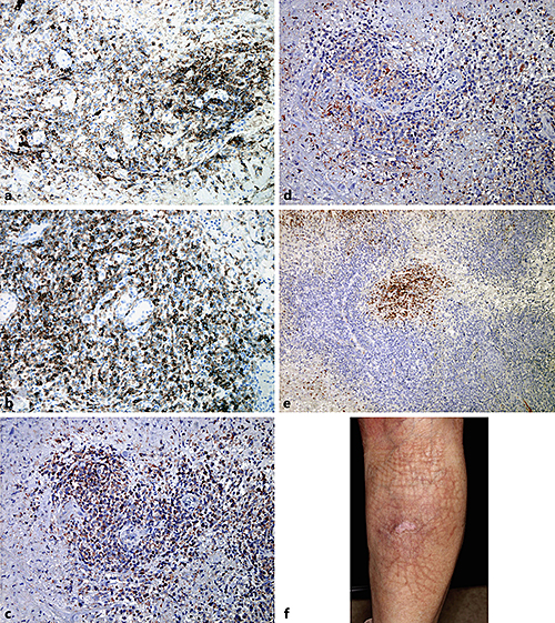 CD30Positive Angioinvasive Lymphomatoid Papulosis (Type E) Developing