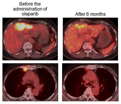 Fig. 1. PET-CT showing that the standardized uptake value in liver and mediastinal lymph metastases decreased six months after treatment with olaparib.