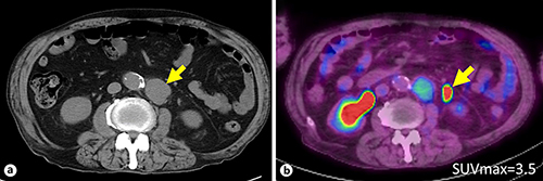 Fig. 1. Axial CT (a) and PET-CT (b).