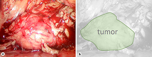 Fig. 2. The tumor was adhered strictly.