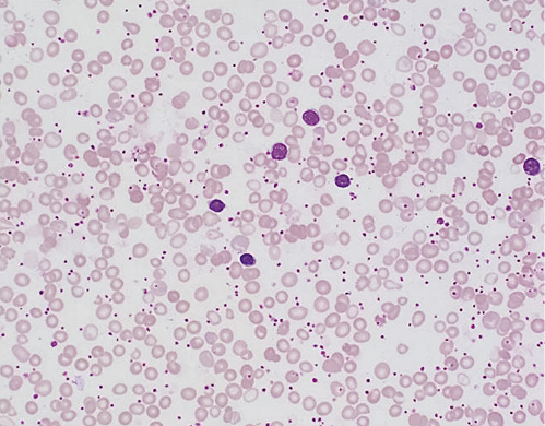 A Rare Case of Severe Copper Deficiency in an Infant with Exclusive ...