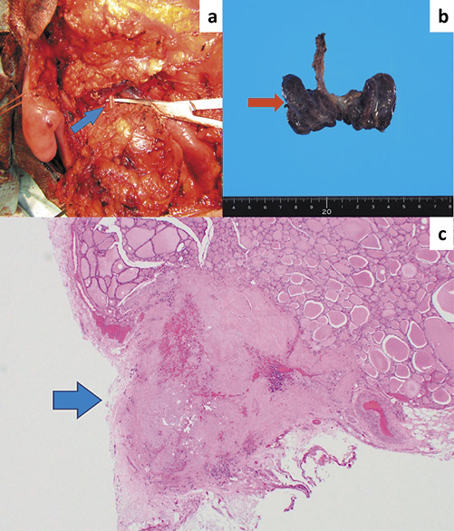 Occult Papillary Thyroid Carcinoma without Detection of the Primary