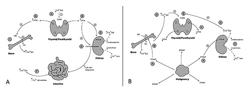 Fig. 1. Normal calcium homeostasis (A) and abnormal calcium homeostasis (B) in humoral hypercalcemia of malignancy. A If/when extracellular calcium (Ca2+ [e]) decreases (A), the calcium-sensing receptor (CaSR) on the parathyroid C cells is inhibited, resulting in increased parathyroid hormone (PTH) secretion (B). Increased PTH acts in the bones and kidneys. The effect of PTH in bone increases osteoclast (OC) function (C). In the kidneys, PTH increases calcium reabsorption in the distal convoluted tubule (D). In addition, PTH increases the activity of 1-α-hydroxylase in the kidneys (E), which in turn increases 1,25-OH vitamin D, thus increasing calcium absorption from the intestines (F). All of these mechanisms are designed to restore/maintain normal serum calcium levels. B PTH-related protein (PTHrP) is secreted by malignant cells (A). Because of its homology with PTH, it interacts with the PTH receptor (PTH-1r) in the bones and kidneys, resulting in increased bone resorption (B) and increased calcium reabsorption (C), respectively. This, in turn, raises extracellular calcium (D), which stimulates CaSR (E), resulting in lower PTH levels (F) [1-4, 9, 13].