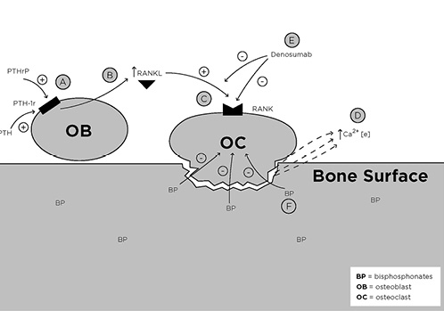 Fig. 2. Effect of parathyroid hormone (PTH), PTH-related protein (PTHrP), bisphosphonates (BPs), and denosumab on bone metabolism. PTH and/or PTHrP bind to the PTH-1r receptor on osteoblasts (A), increasing the production of RANKL (B). RANKL binds to RANK receptors on osteoclasts (C), activating bone resorption, leading to calcium efflux into the extracellular space (D). Denosumab inhibits this process by binding to RANKL to prevent its binding to the RANK receptor (E). BPs in the bone matrix directly inhibit osteoclast function (F). Both of these actions decrease calcium efflux into the extracellular space [1, 2, 9, 15, 16].