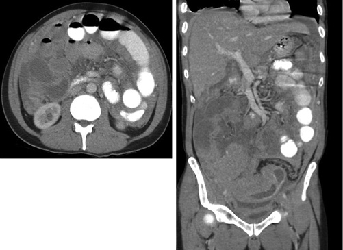 Fig. 1. CT scans of the abdomen and pelvis with double contrast.