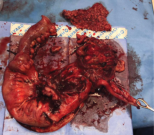 Fig. 2. Excised specimen involving the ileocecal region with its mesentery and part of the peritoneum.