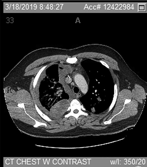 Fig. 1. CT chest with contrast status after pembrolizumab (03/2019), continued disease progression.