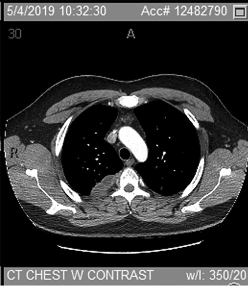 Fig. 2. CT chest with contrast status after 2 months of pazopanib (05/2019), significant disease regression.