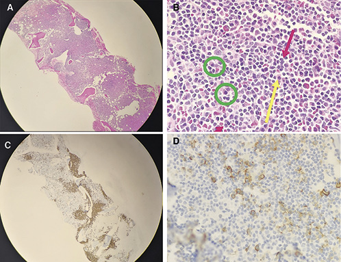Fig. 1. Bone marrow trephine biopsy. A Bone marrow trephine at ×4 magnification, showing hypercellular bone marrow and hyperchromatic areas of nodular and paratrabecular infiltrates. B Bone marrow trephine at ×50 magnification. The hyperchromatic areas comprise small lymphoid cells with mature appearance (red arrows), admixed plasma cells (green circles) and associated mast cells (yellow arrow). C Bone marrow trephine immunohistochemistry. CD20 highlights the B-lineage infiltrate with the paratrabecular and nodular infiltrate comprising about 30% of the marrow surface area. D Bone marrow trephine Immunohistochemistry. CD138 staining highlights the admixed plasma cells.
