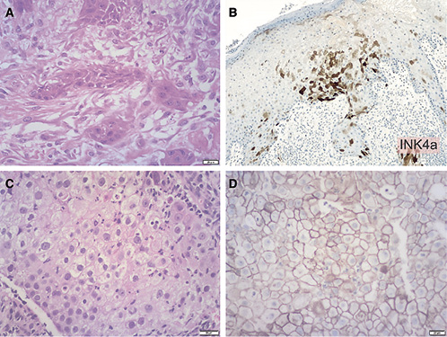 Fig. 2. Histopathology. A High-power view of the skin demonstrating an invasive well-differentiated keratinizing squamous cell carcinoma. B p16INKa stain showed a positive block pattern of staining. C Histology of the apical lung mass confirmed a moderately differentiated squamous cell carcinoma, with some areas suggestive of glandular differentiation and some areas of clear cell vacuolated cytoplasm. D PD-L1 was strongly positive in more than 95% of tumor cells (TPS >95%).
