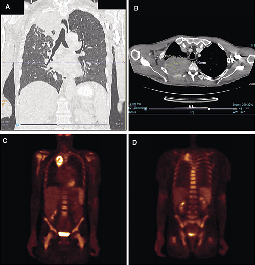 Fig. 3. Imaging. A Computed tomography chest scan – coronal view, demonstrating a large right apical lung mass and right lower lobe nodule. B Computed tomography chest scan – axial view, demonstrating a large apical lung mass with posterior chest wall infiltration and erosion of the third rib. C, D F-18 FDG PET/CT – coronal views, demonstrating diffuse radiotracer uptake throughout the appendicular and axial skeleton (with the highest SUVmax of 4.81) and a metabolically active apical lung mass (SUVmax 3.76).