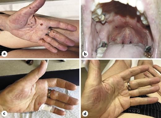 Fig. 1. Clinical presentation of BP induced by pembrolizumab. a Initially at diagnosis with tense blisters on the palmar face of hands. b Mucosal erosion of the hard palate. c, d After 4 weeks and after 8 weeks of tapering oral prednisolone. BP, bullous pemphigoid.