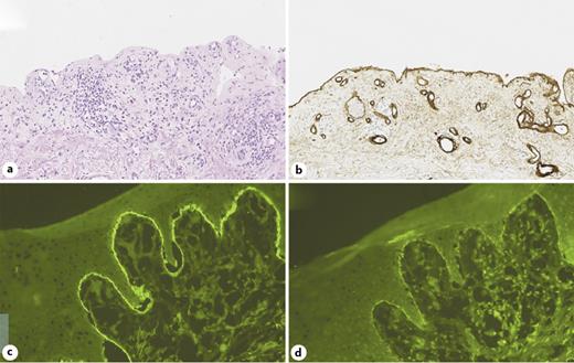 Fig. 2. Microscopic examination of blistered skin punch biopsy. a Complete blistering of the epidermis and an infiltrate of eosinophilic granulocytes in the dermis with persistent dermal papillary festooning in hematoxylin-and-eosin staining. b Persistent collagen IV-positive basal membrane at the floor of the blister in immunohistochemistry staining. c, d Linear deposition of C3 complement and immunoglobulin G at epidermal BMZ under DIF study. DIF, direct immunofluorescence; BMZ, basement membrane zone.