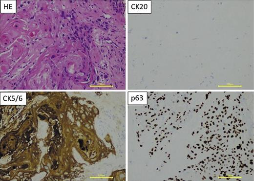 Fig. 2. Pathology revealed a nest of malignant squamous cells, with cytoplasmic keratinization and heterocysts of various karyotype sizes and shapes (HE staining; scale, 100 μm). This was accompanied by keratinization without clear lumen-like structures. pSCC diagnosis; negative CK20, positive CK5/6, positive p63. pSCC, prostate squamous cell carcinoma.