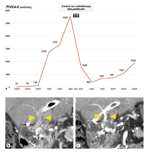 Controlling Major Portal Vein Invasion Progression during Lenvatinib