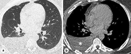 Fig. 1. a, b Axial noncontrast CT scan revealed right-sided pleural effusion without underlying parenchyma lesion. CT, computed tomography.