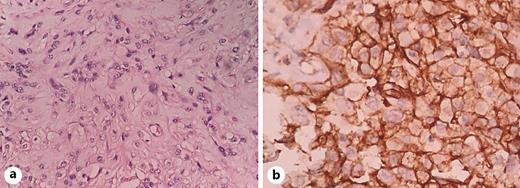 Fig. 2. Pleural biopsy specimen. a Hematoxylin and eosin staining exhibited a nest of atypical epithelioid cells with vacuolated cytoplasm. b Membranous CD31 immunostaining.