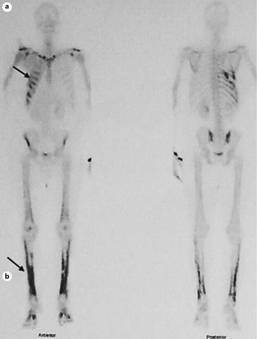 Fig. 3. Bone scan showed increased radiopharmaceutical uptake: in right hemithorax (postoperative changes) (a), along both tibial cortexes suggesting HPO (b). HPO, hypertrophic pulmonary osteoarthropathy.