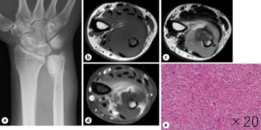 Fig. 2. Image findings 8 months after the initial surgery. a Radiograph showed an ossified lesion with a multilobular surface in the distal ulna, with an associated soft tissue mass. b–d MRI showed a T1 low-signal (b), T2 high-signal (c), gadolinium contrast-enhanced (d) tumor approximately 8 cm in size with bony destruction and extraskeletal infiltration. e Incisional biopsy showed spindle cell proliferation in a fascicular pattern with marked nuclear atypia, mitosis, and osteoid formation, suggesting a high-grade osteosarcoma.
