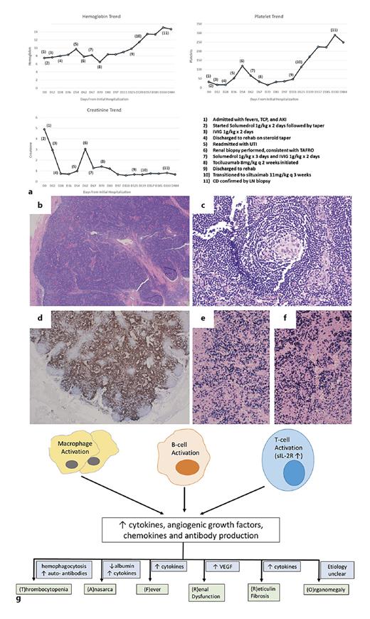 TAFRO Syndrome and Elusive Diagnosis of Idiopathic Multicentric