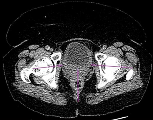 Fig. 2. CT image of the pelvis showing enhanced posterior bladder wall thickening (arrows).