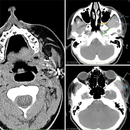Ewing’s of Mandible Practical Approach to a Challenging Case