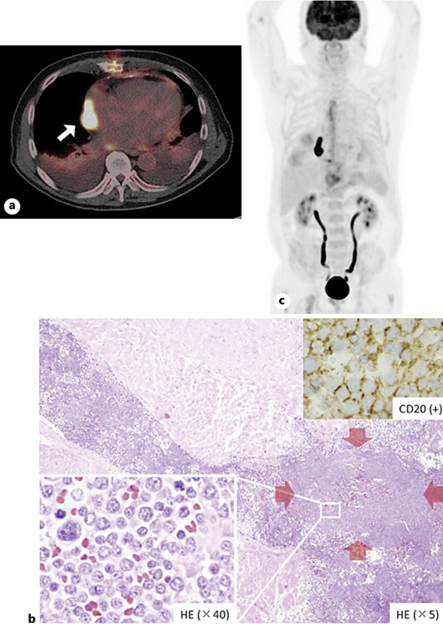 Metabolic Steal of the Myocardium by Primary Cardiac Lymphoma Case