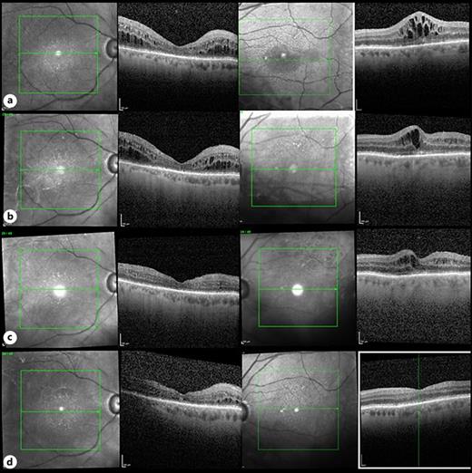 Bilateral Cystoid Macular Edema with Zanubrutinib Therapy A Case
