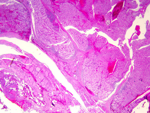 Pathology slide from biopsied thyroid gland and isthmus demonstrating metastatic clear cell renal carcinoma. Tumor cells can be seen in nests and sheets surrounded by an intricate meshwork of branching capillaries. H&E stain and ×2 magnification.