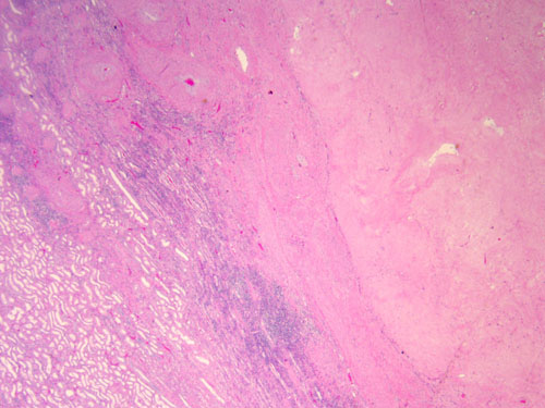 Pathology slide from excised renal mass demonstrating fibroxanthomatous inflammation consistent with therapeutic effect on renal neoplasm and no viable cancer cells. ×2 magnification.
