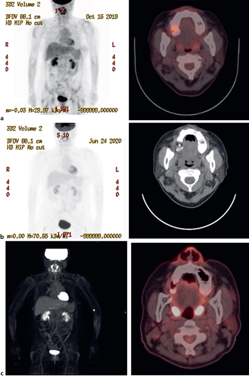MedicationRelated Osteonecrosis of the Jaw Successful Medical