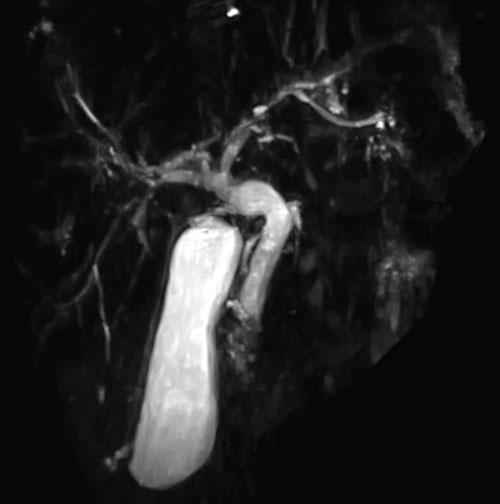 Pembrolizumab Induced Sclerosing Cholangitis Why You Need a Liver