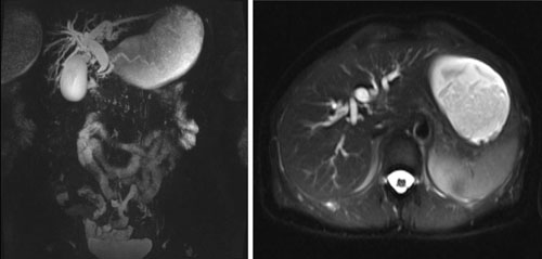 Magnetic resonance cholangiography showing dilatation of the choledocus, intrahepatic, and common bile ducts.