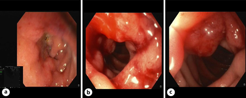 EUS showing a structure of the second portion of the duodenum (a) with erythematous mucosa (b) and protrusion of the ampulla of Vater (c).