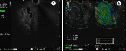 EUS showing dilatation of main pancreatic duct (a) with preserved pancreatic parenchyma (b).