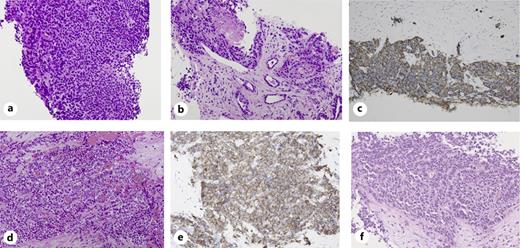 Histopathological findings of the present case. Prostate biopsy revealed a mixture of small-cell carcinoma (a) and acinar (b) components of the prostate. Hematoxylin and eosin staining. c Immunohistochemistry (IHC) for synaptophysin in the initial prostate biopsy. d Prostate tissue resected using transurethral resection (TUR) of the prostate after castration-resistant prostate cancer. e IHC for synaptophysin in the TUR specimen. f Liver biopsy specimen after CRPC.