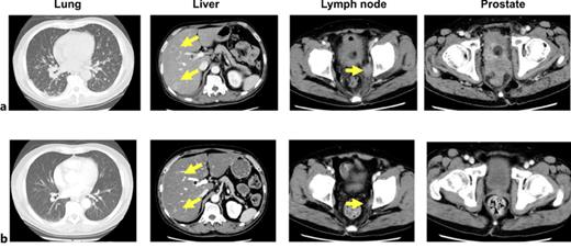 Longitudinal changes in radiographic findings before and after (4 months) chemotherapy with carboplatin and etoposide or a poly ADP-ribose polymerase inhibitor. CE, carboplatin and etoposide; PARPi, poly ADP-ribose polymerase inhibitor.