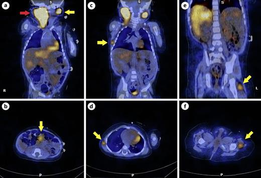 The diagnostic meta-iodobenzylguanidine scans of the patient. a Sagittal view of the primary cervical neuroblastoma (red arrow) and contralateral metastasis to the lymph nodes (yellow arrow). b Transverse view of the abdominal metastasis (yellow arrow). c Sagittal view of the thoracic soft tissue metastasis (yellow arrow). d Transverse view of thoracic soft tissue metastasis (yellow arrow). e Sagittal view of the soft tissue metastasis (yellow arrow) in the upper left leg. f Transverse view of the soft tissue metastasis (yellow arrow) in the upper left leg.