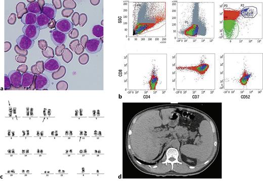 Findings at diagnosis. a Bone marrow smear showed an increase in abnormal lymphocytes with round nuclei, visible nucleoli, and non-granular basophilic cytoplasm. b Flow cytometric analysis of peripheral blood detected abnormal T lymphocytes. The search for membrane CD3 (mCD3) and cytoplasmic CD3 (cyCD3) demonstrates that the major clones (red: 94.6%) display the aberrant mCD3(−), cyCD3(+) phenotype, whereas the minor clones (blue: 0.1%, green: 0.8%) display the mCD3(+), cyCD3(+) and mCD3(−), cyCD3(−) phenotype, respectively. c G-banding cytogenetic analysis of bone marrow aspirate showed complex karyotype with multiple chromosomal aberrations: 46,XY,add(1)(p11),?del(1)(q?),add(3)(q21),add(11)(q13),inc. d CT showed splenomegaly and lymphadenopathy.