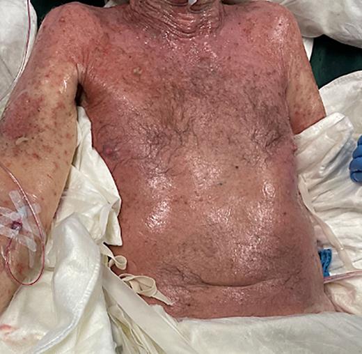 ApalutamideInduced Toxic Epidermal Necrolysis in a Caucasian Patient