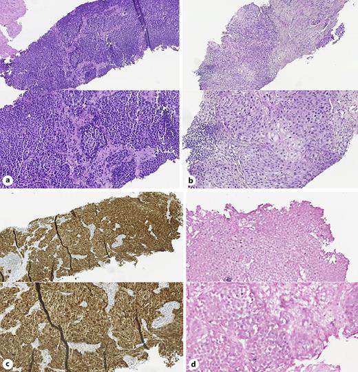 Advanced Female Primary Urethral Carcinoma with Nodal Extension Managed
