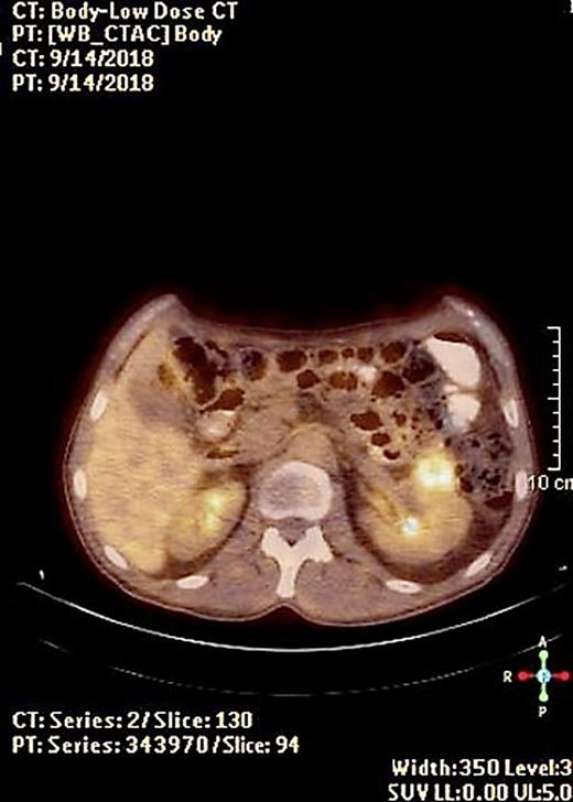 A Chromosome 9p24.1 Amplification in Colorectal Cancer with Metastases