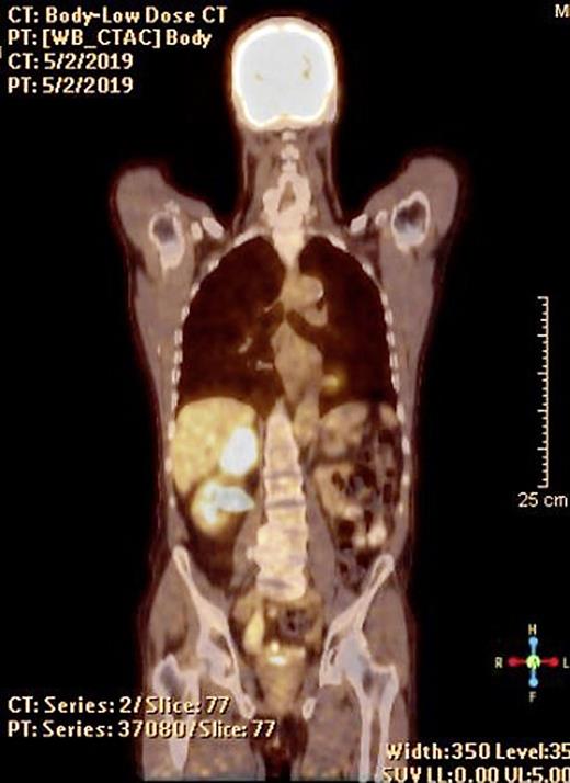 A Chromosome 9p24.1 Amplification in Colorectal Cancer with Metastases