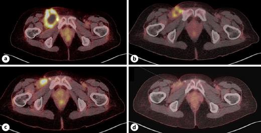PET/CT evaluations from the start of pembrolizumab. a Baseline PET/CT (December 2021), before the start of ICI therapy. b Metabolic partial response after 3 months of ICI therapy (April 2022). c Further metabolic response after 3 months of ICI therapy (July 2022).