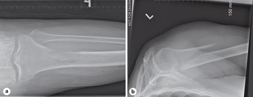 a Pathological tibial fracture due to a permeative lytic lesion coupled with cortical disruption. b Displaced left humeral fracture.