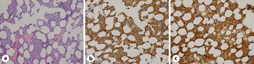 a Bone marrow infiltration by neoplastic plasma cells. Hematoxylin and eosin staining. Objective ×60. b Plasma cells expressing bright cytoplasmic CD138 expression. c Lambda light chain restriction. Objective ×40.