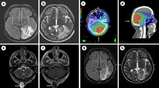 Axial FLAIR (a) and T2WI (b) images show a heterogenous left occipital lobe cortical base intra-axial mass that is predominantly high on T2WI. c, d Radiotherapy plan for high-grade glioma, showing the dose to the what later became an STS. e, f Interval development of extracranial suboccipital mass demonstrates heterogeneous high-signal intensity on T2 and peripheral enhancement and nodularity on post-contrast T1WI. g, h Interval progression of the recurrent high-grade left occipital tumor on FLAIR and T2WI.
